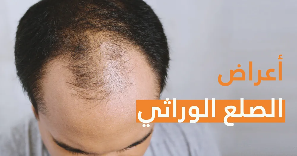 أعراض الصلع الوراثي 